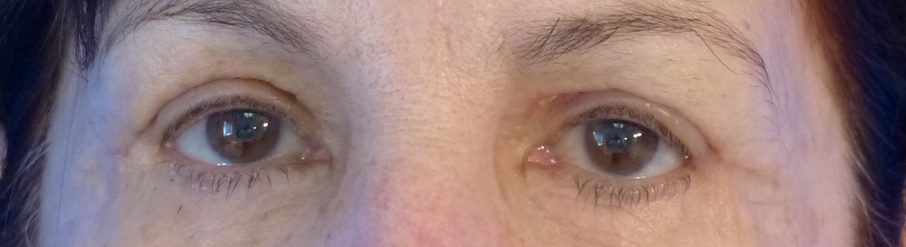 harley blepharoplasty