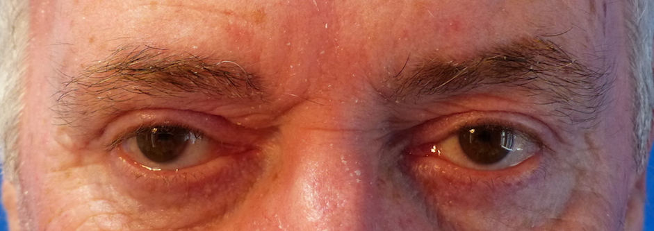 oliver harley eyelid surgery