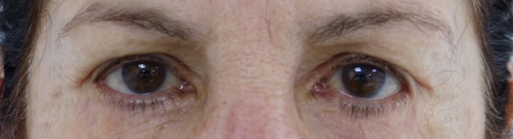harley eyelid surgery