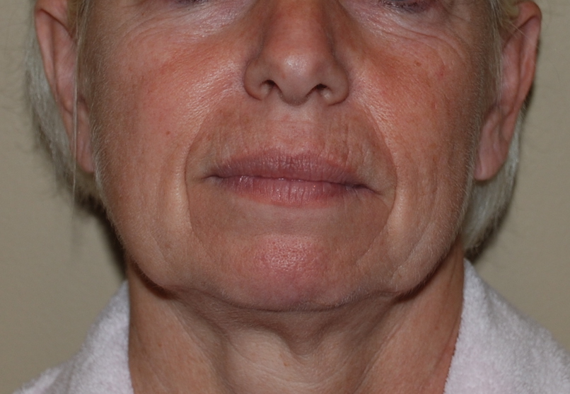 facelift pre operative harley plastic surgery