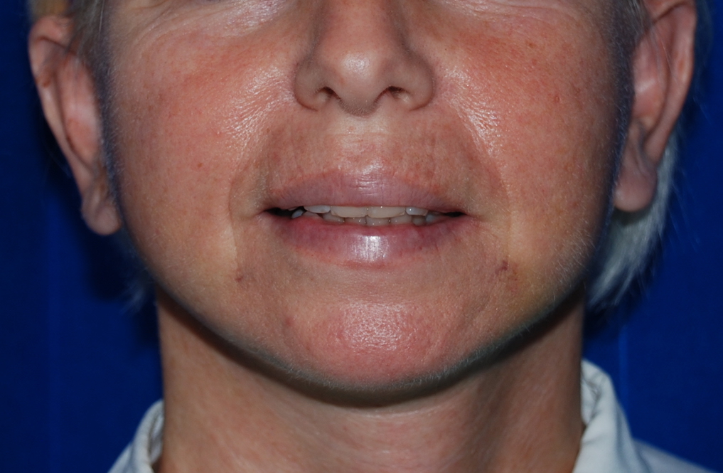 face lift post op harley plastic surgery