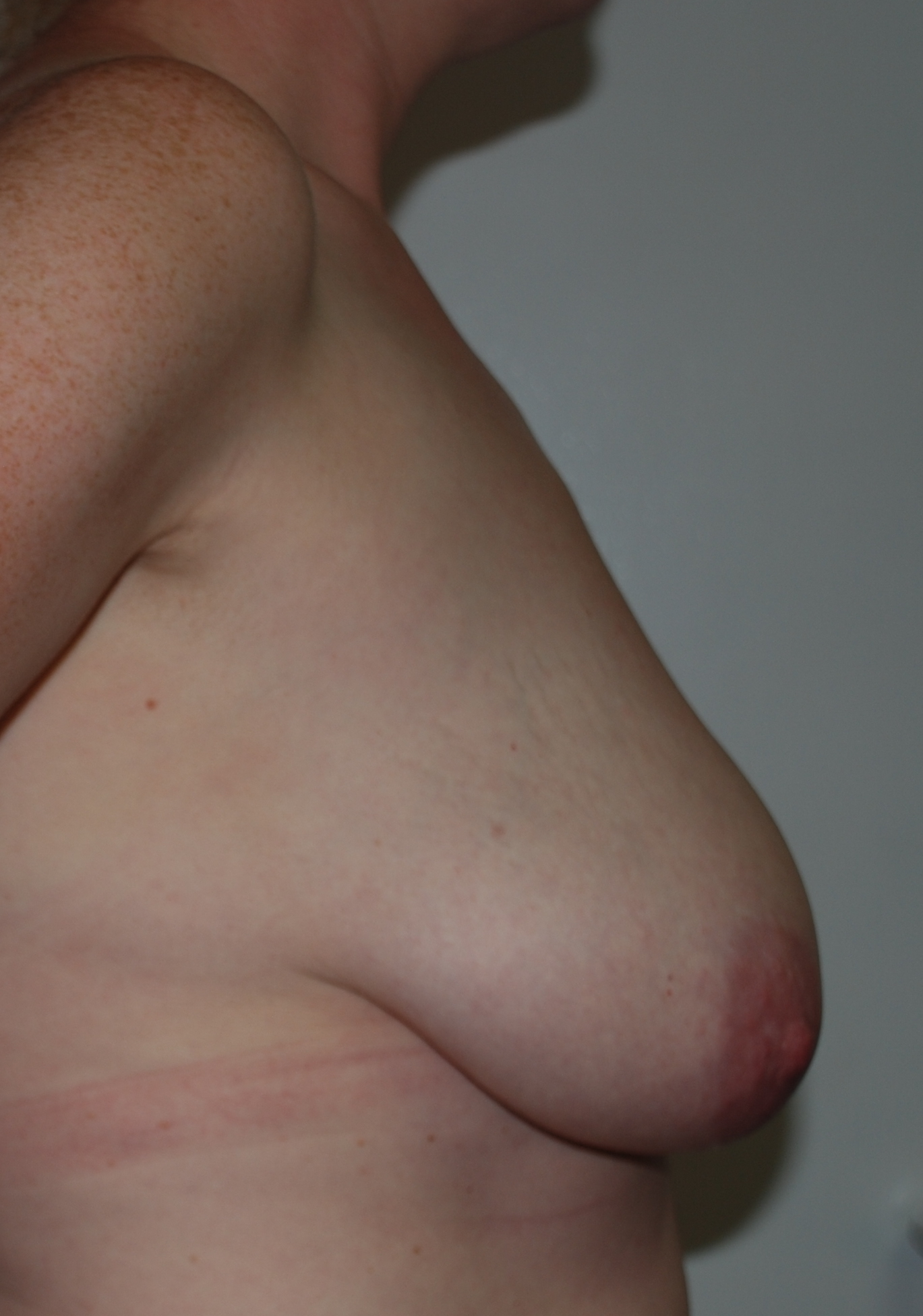 mastopexy breast uplift