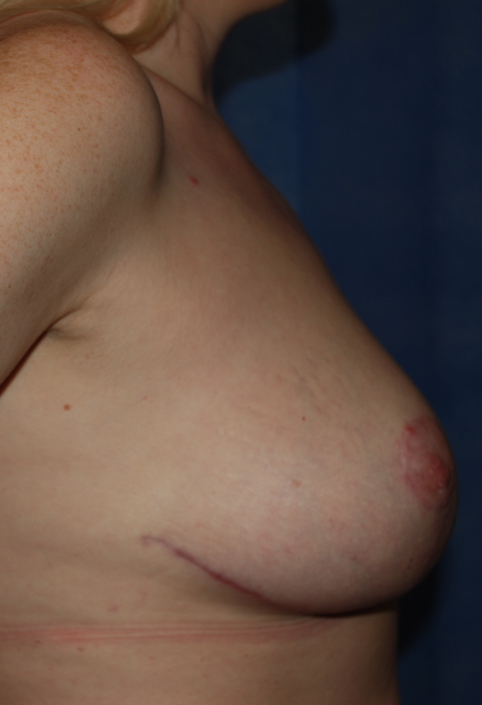 mastopexy breast uplift