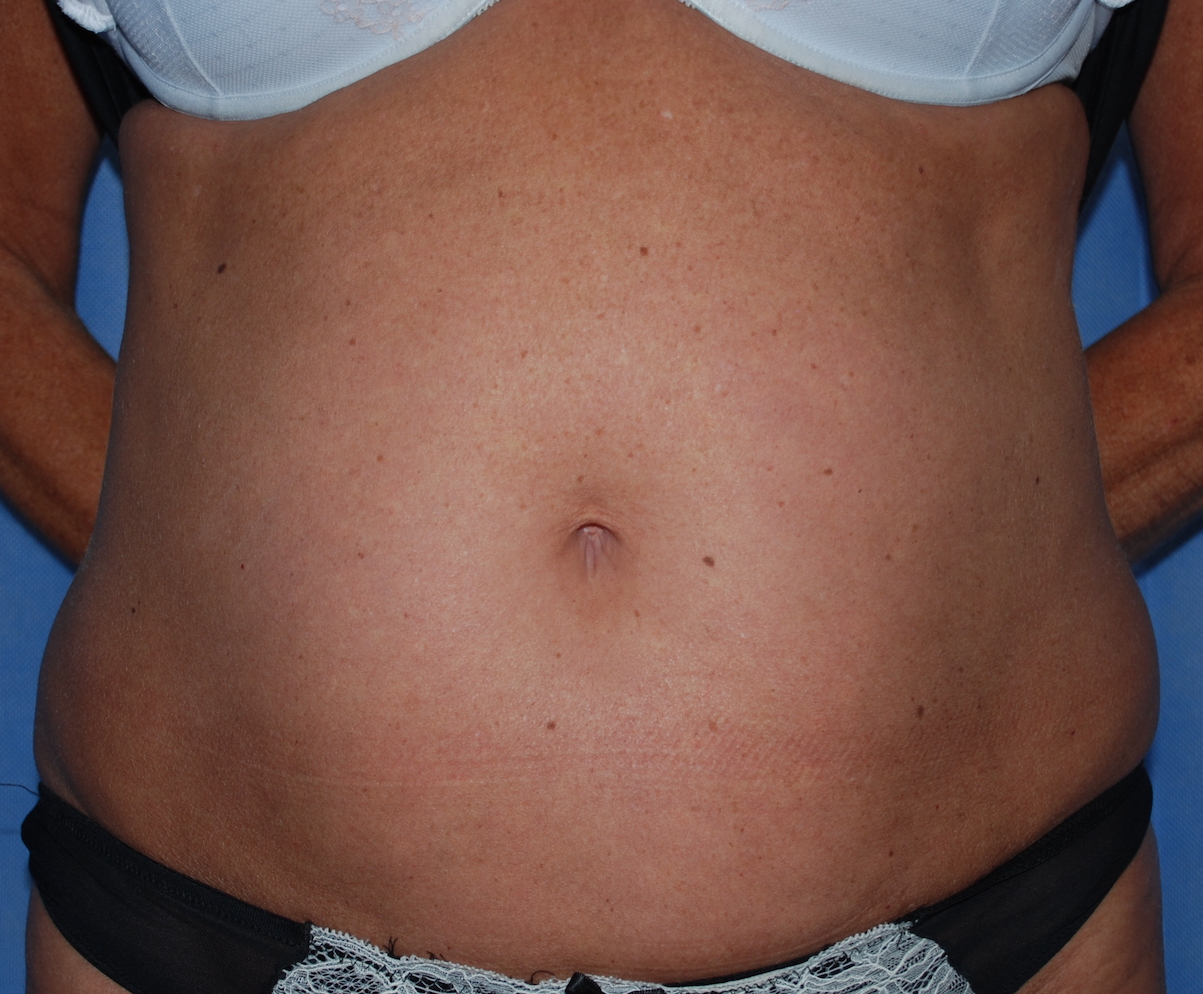 Liposuction Harley Plastic Surgery