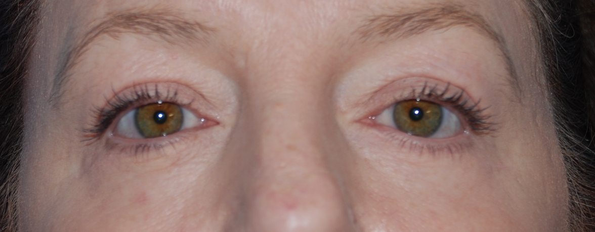 eyelid surgery east grinstead harley