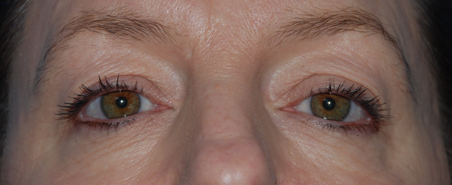 eyelid surgery cosmetic