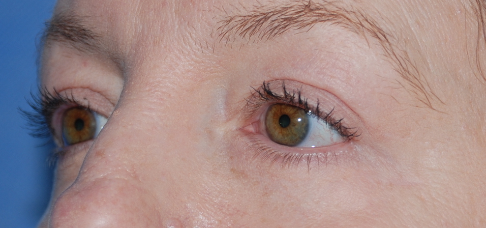 upper and lower eyebags cosmetic surgery