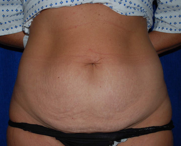 abdominoplasty before surgery