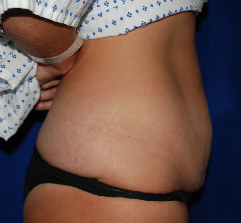 tummy tuck