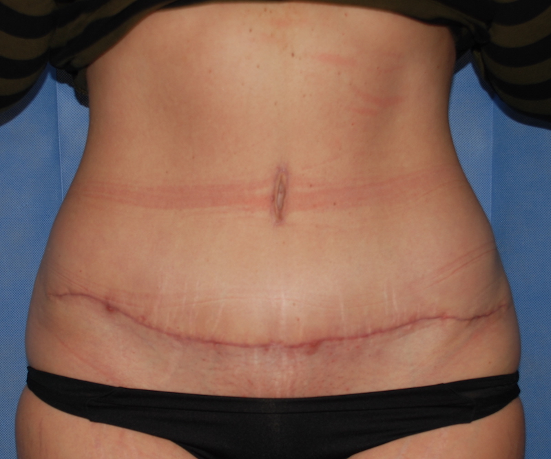 abdominoplasty after surgery