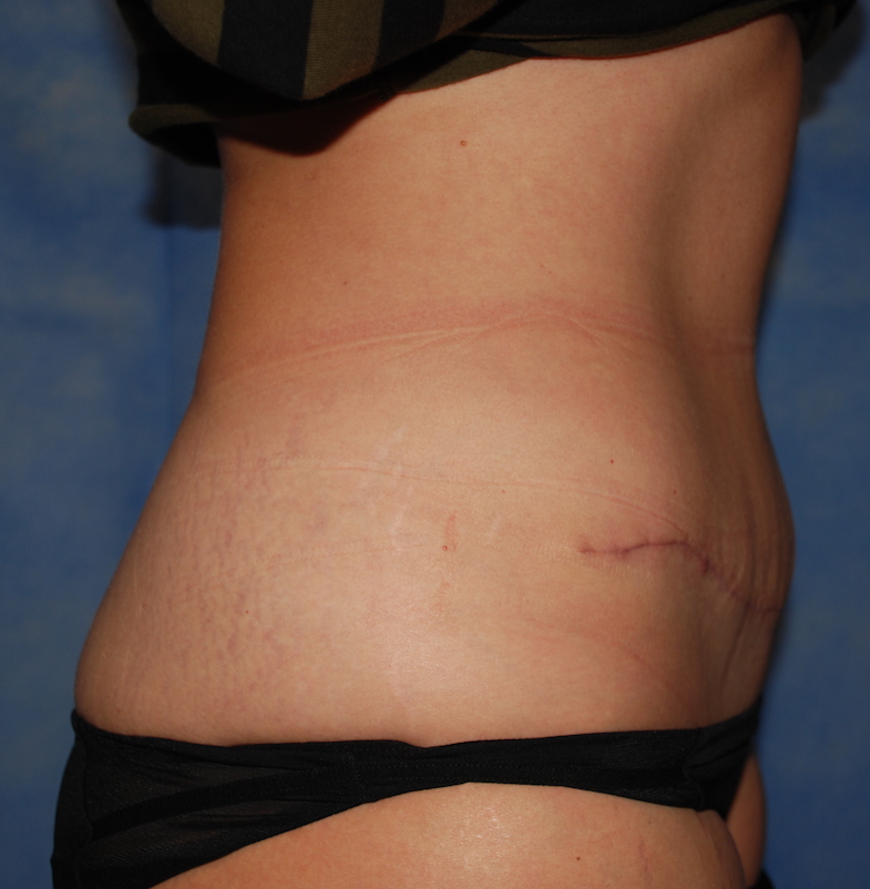 tummy tuck after surgery