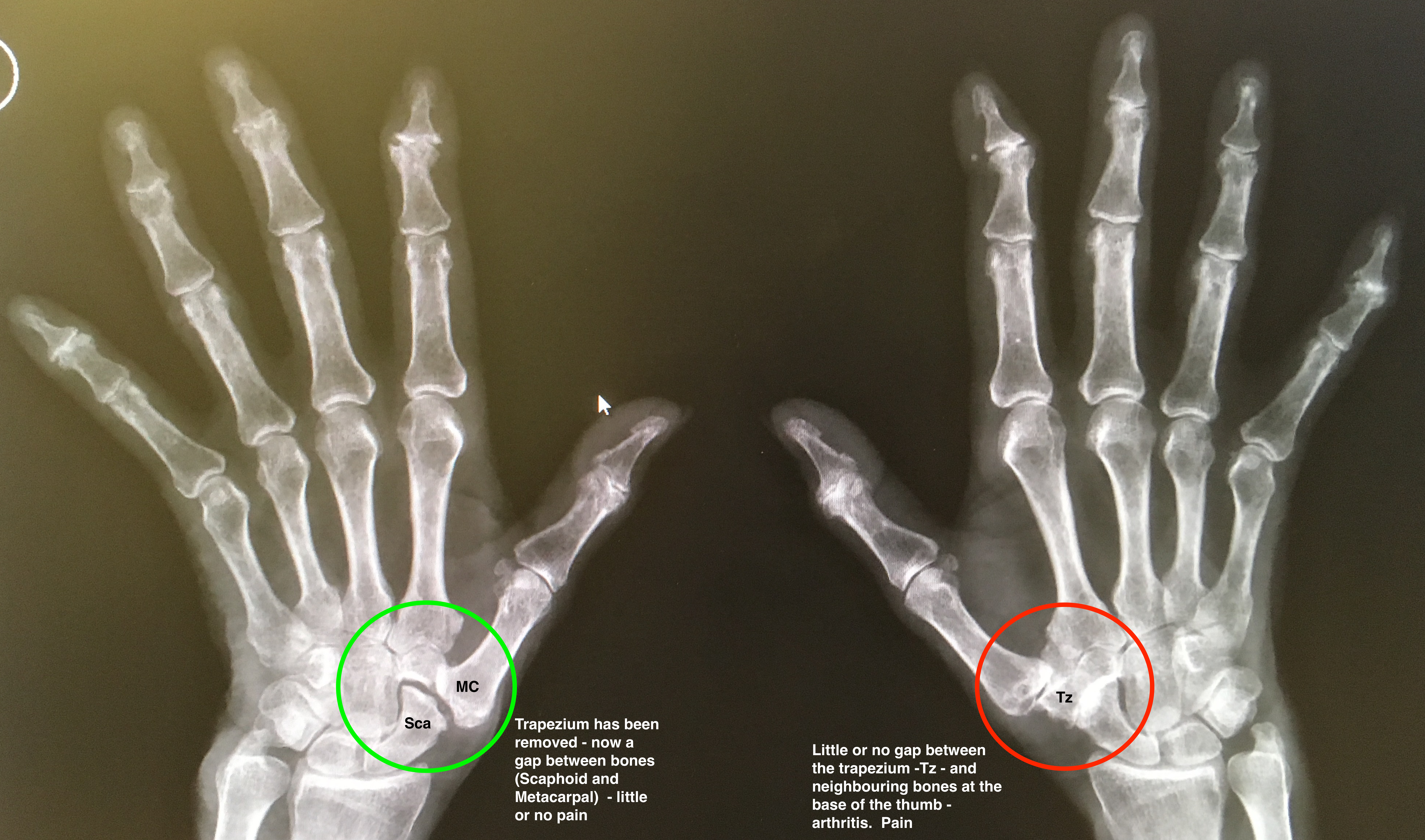 trapeziectomy thumb arthritis harley