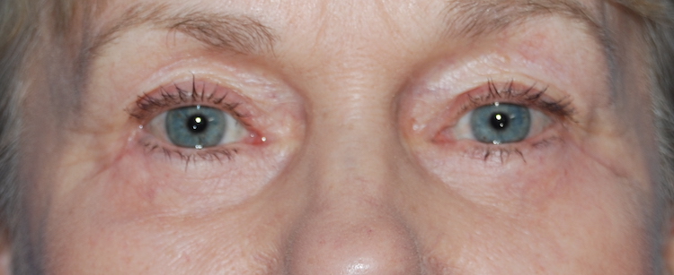 baggy eyes cosmetic surgery harley