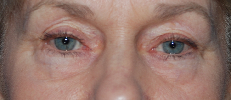 lower blepharoplasty crawley