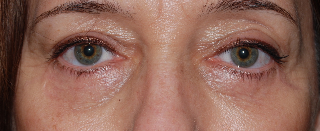 lower eyelid cosmetic surgery sussex