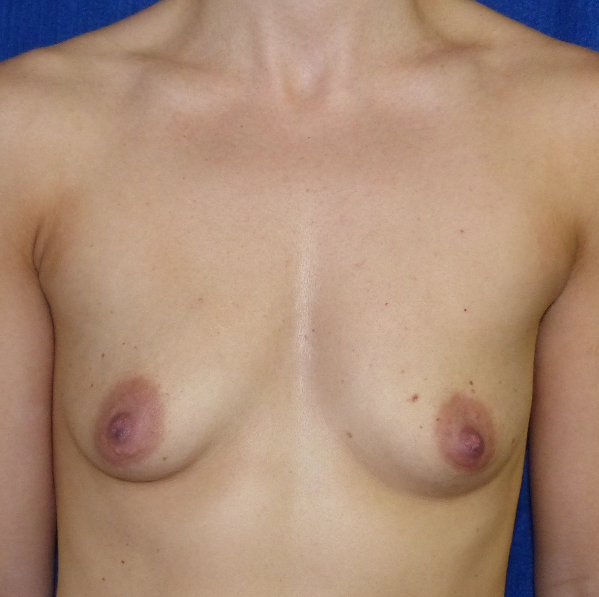 breast augmentation pre-op