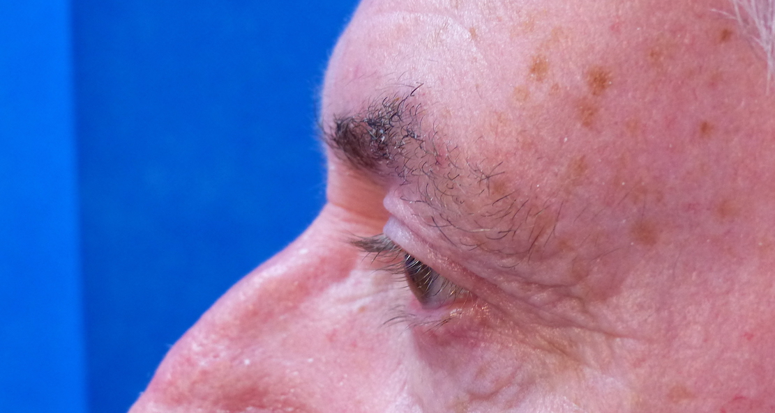 harley male upper blepharoplasty