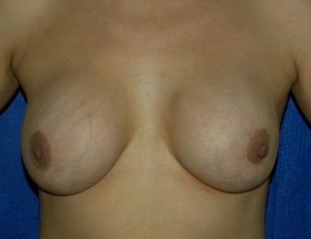 breast implant exchange pre - op