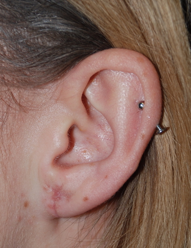ear spacer repair harley brighton
