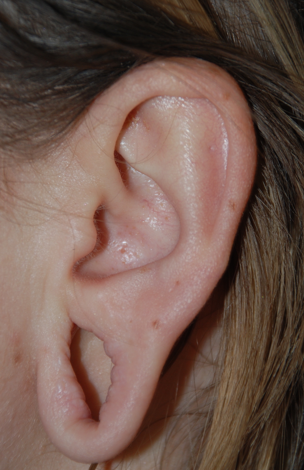 stretch earlobe repair oliver harley cosmetic surgery