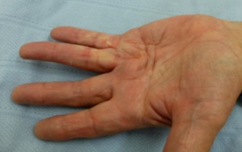 dupuytrens contracture before needle fasciotomy