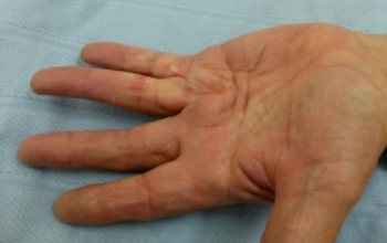 contracture dupuytrens fasciotomy