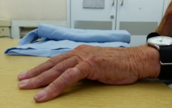 dupuytrens contracture before treatment.  not able to straighten fingers