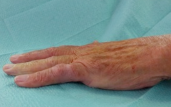 dupuytrens contracture treated successfully with needle fasciotomy