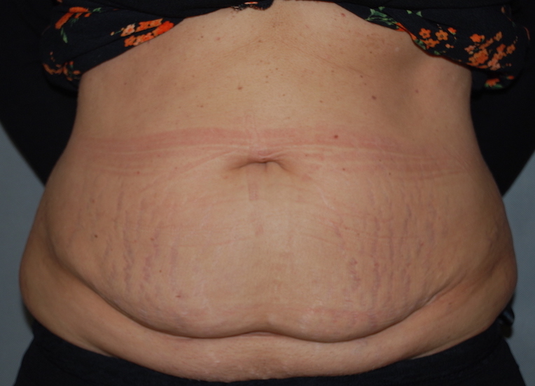 tummy tuck liposuction harley cosmetic