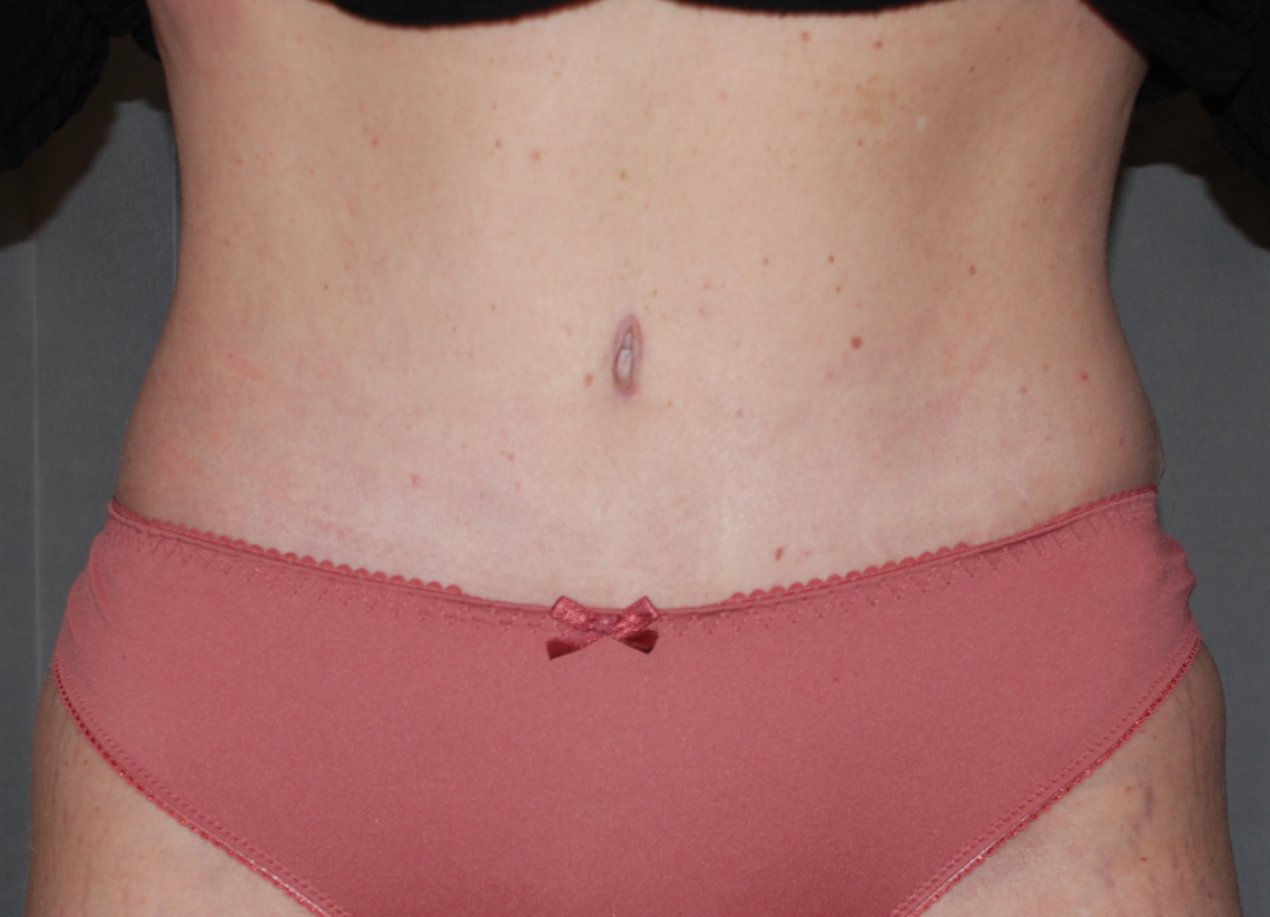 tummy tuck liposuction harley plastic surgery brighton