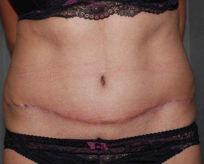 tummy fold lipoabdominoplasty