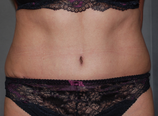 tummy tuck and liposuction harley cosmetic maidstone