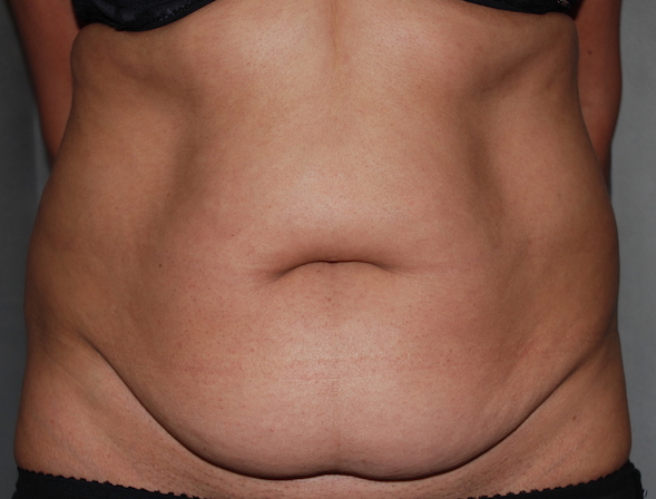 mummy tummy lipoabdominoplasty