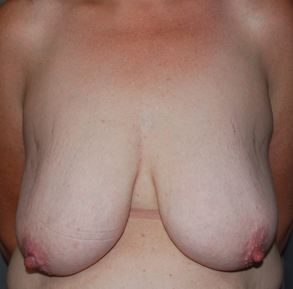 breast uplift oliver harley plastic surgery