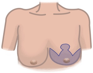 breast reduction wise pattern diagram of technique