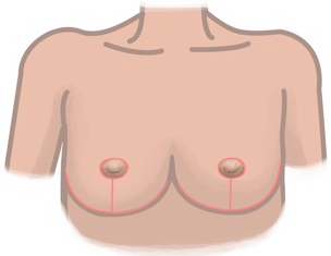 breast reduction diagram technique and pattern of inverted t scar