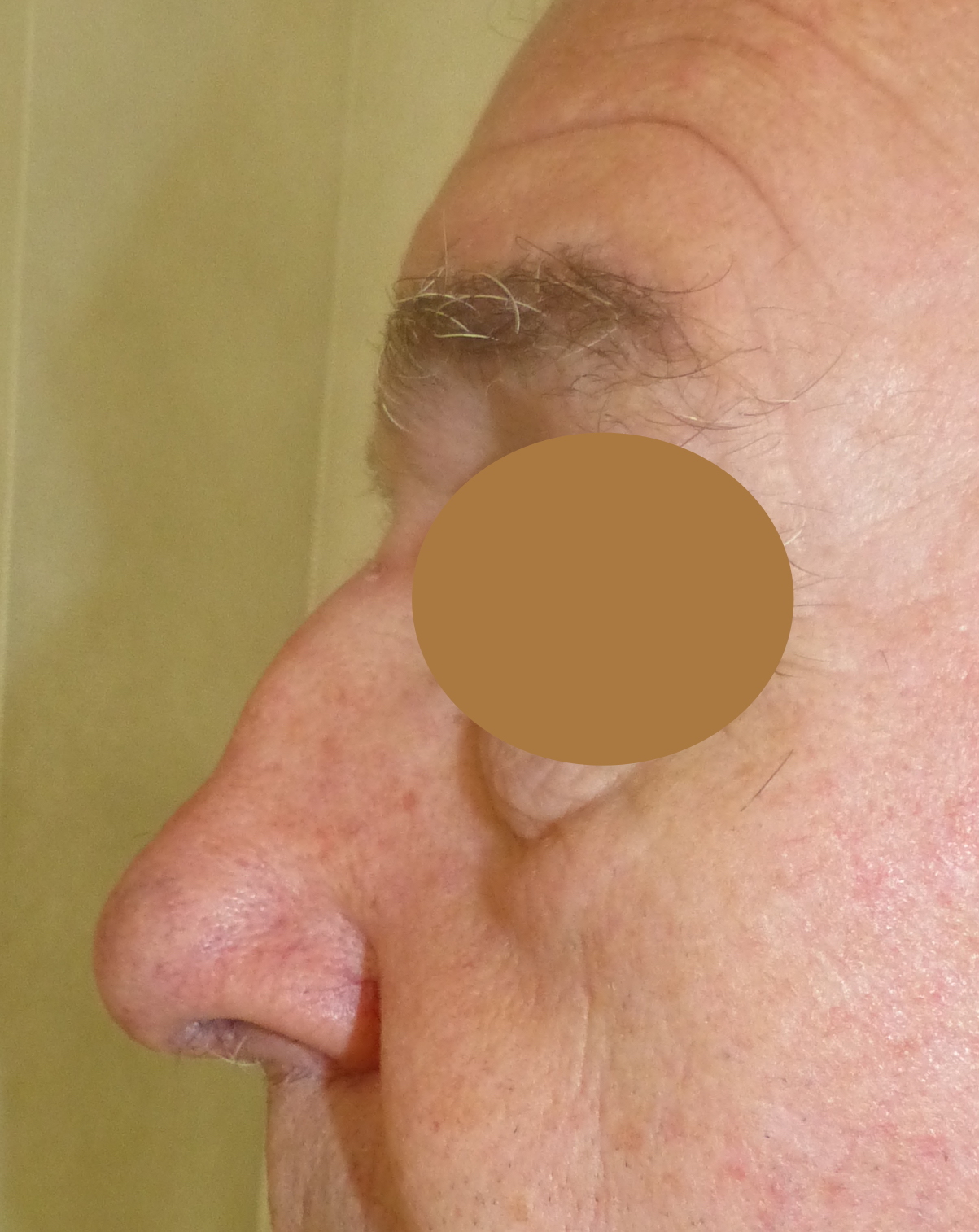 male nose job harley cosmetic surgery