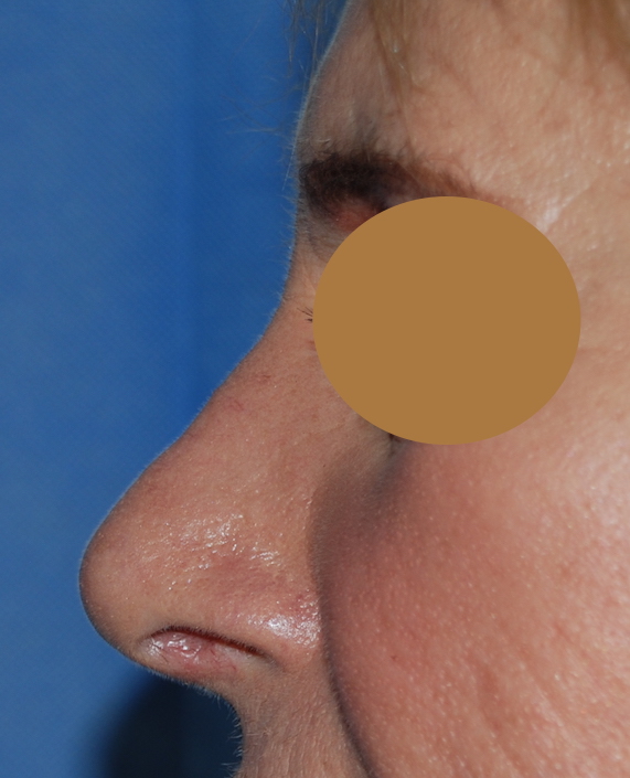 nose refinement rhinoplasty harley cosmetic sussex