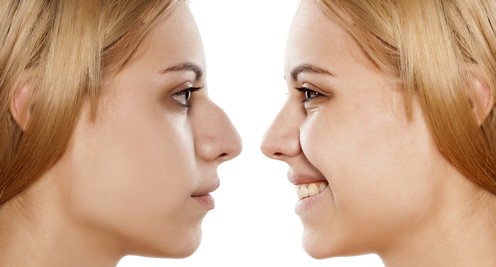 Nose Reshaping