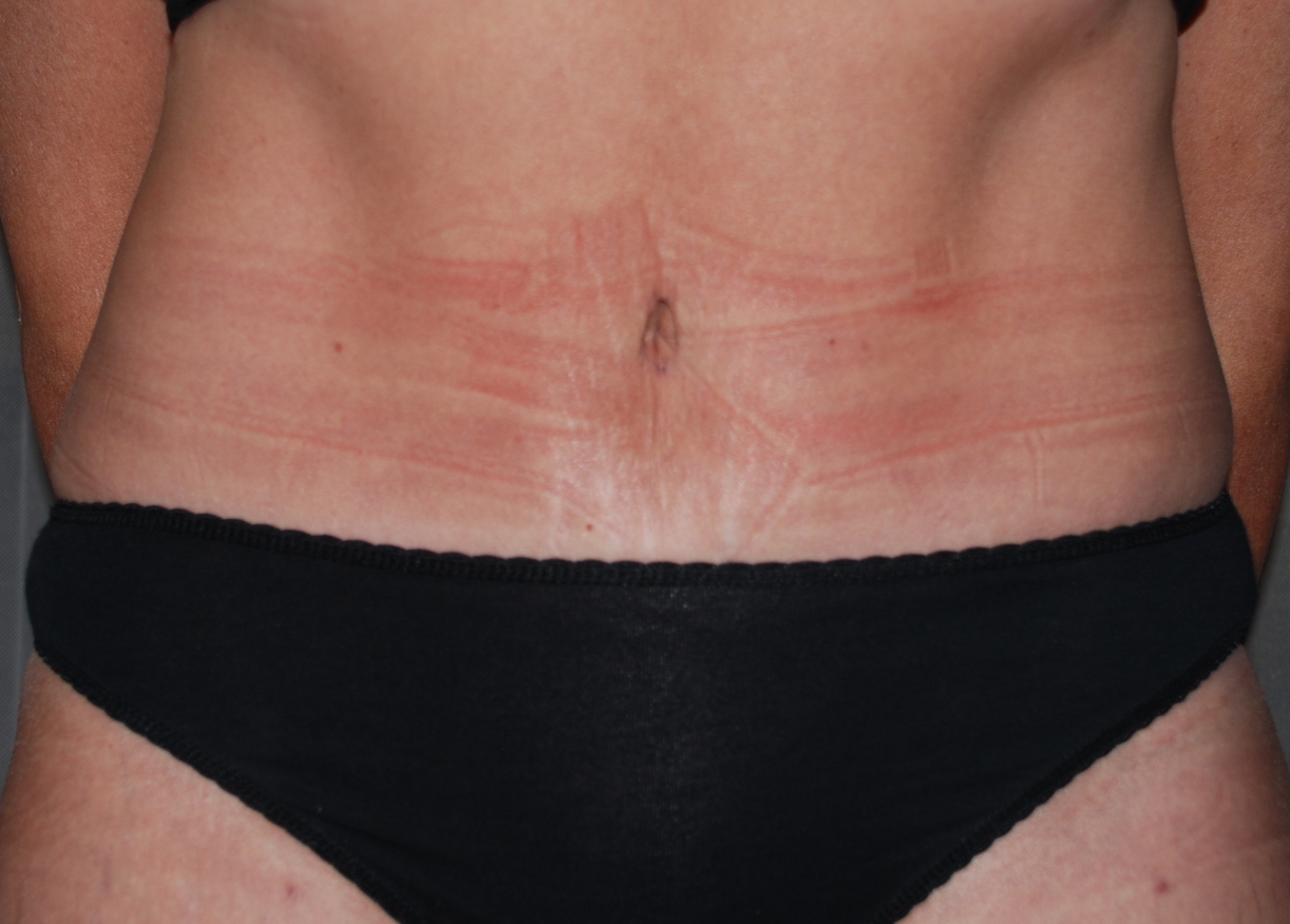 tummy fold cosmetic surgery harley london