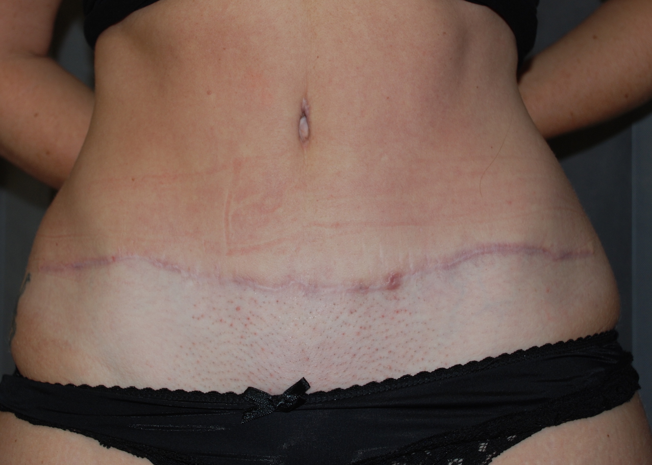 tummy tuck KIMS hospital harley