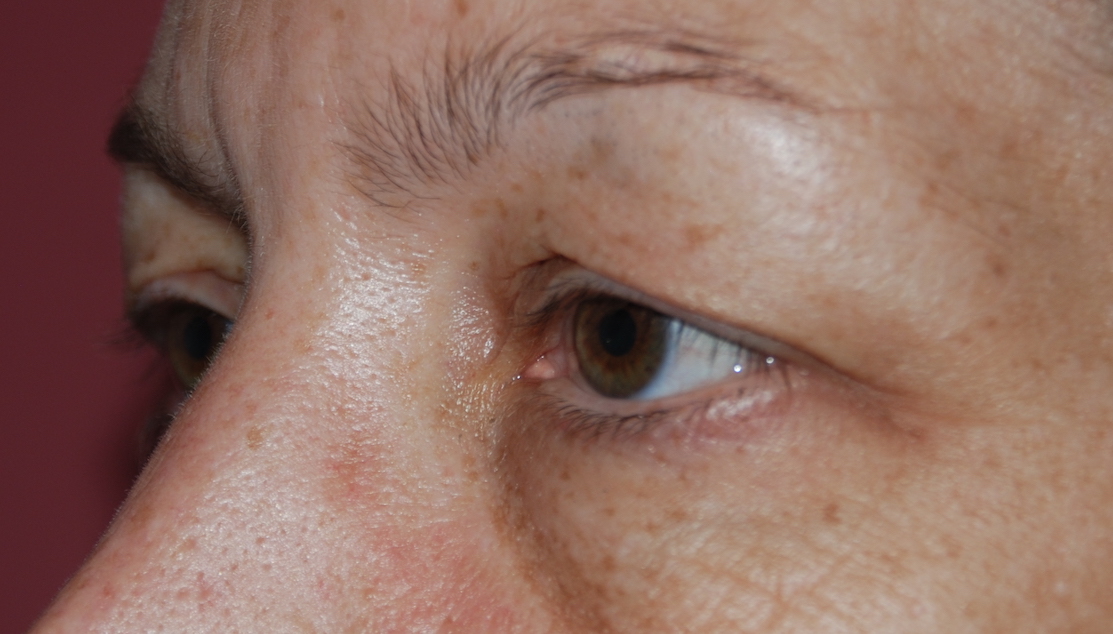 eyelid folds cosmetic surgery