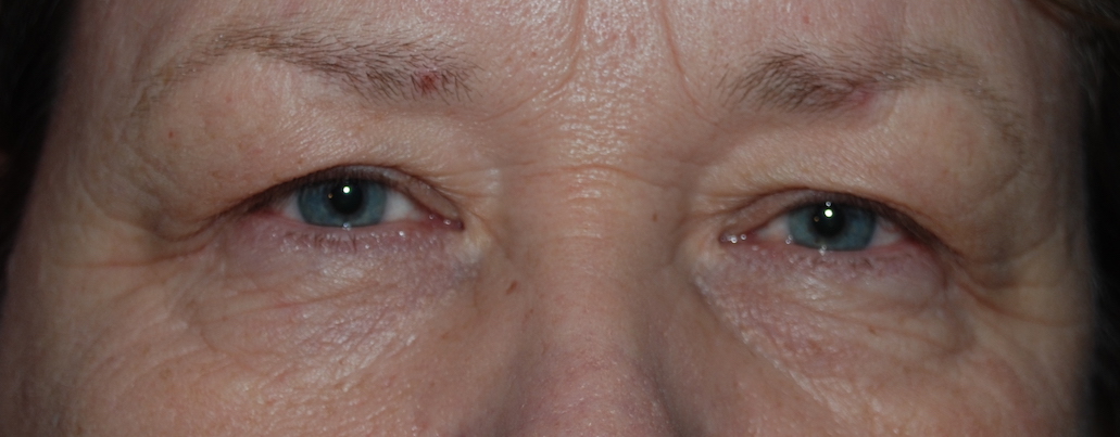 upper blepharoplasty mcindoe centre sussex