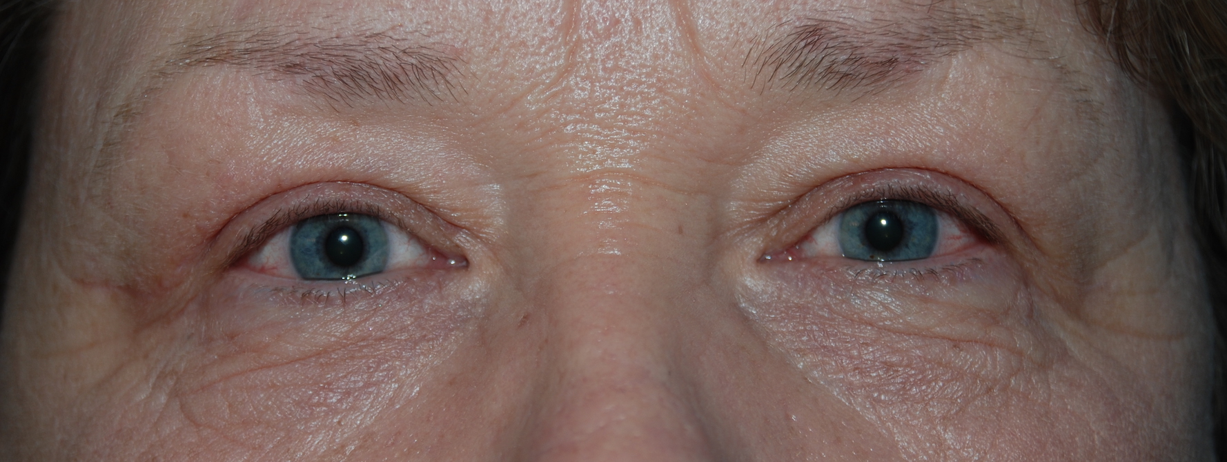 upper eyelids mcindoe centre east grinstead