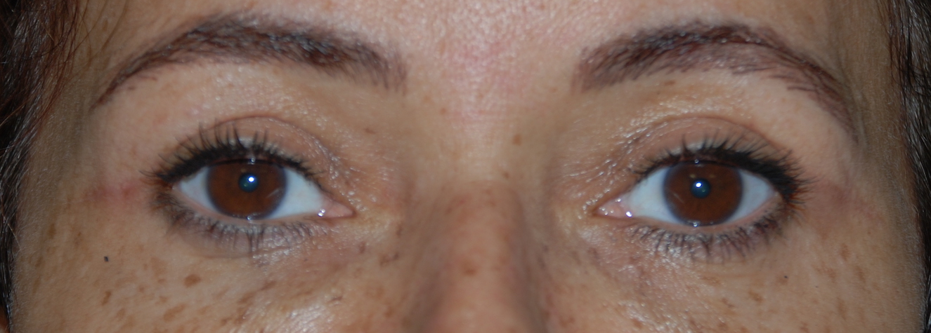 upper eyelid cosmetic harley brighton