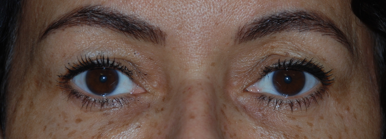 eyelid cosmetic surgery harley london