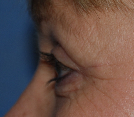 eyelid surgery harley london