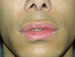 lip lift oliver harley plastic surgeon before op