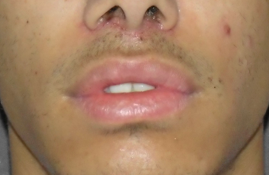 lip lift upper lip