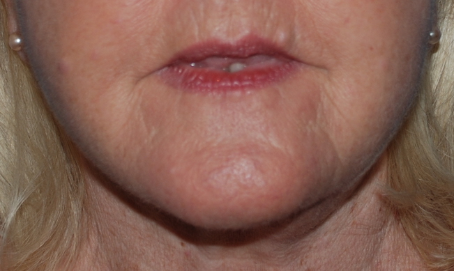 facelift cosmetic surgery sussex